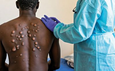 WHO Director-General declares mpox outbreak a public health emergency of international concern